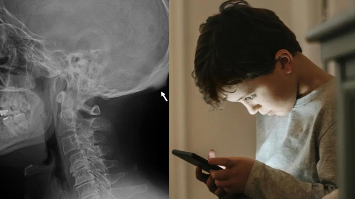 ¿Qué es el ’cuerno del celular’?... el espolón óseo que aparece por su uso prolongado y podría ser peligroso